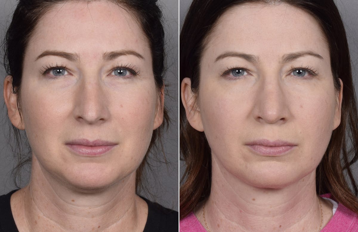 Rhinoplasty Before & After Gallery - Patient 418400 - Image 3