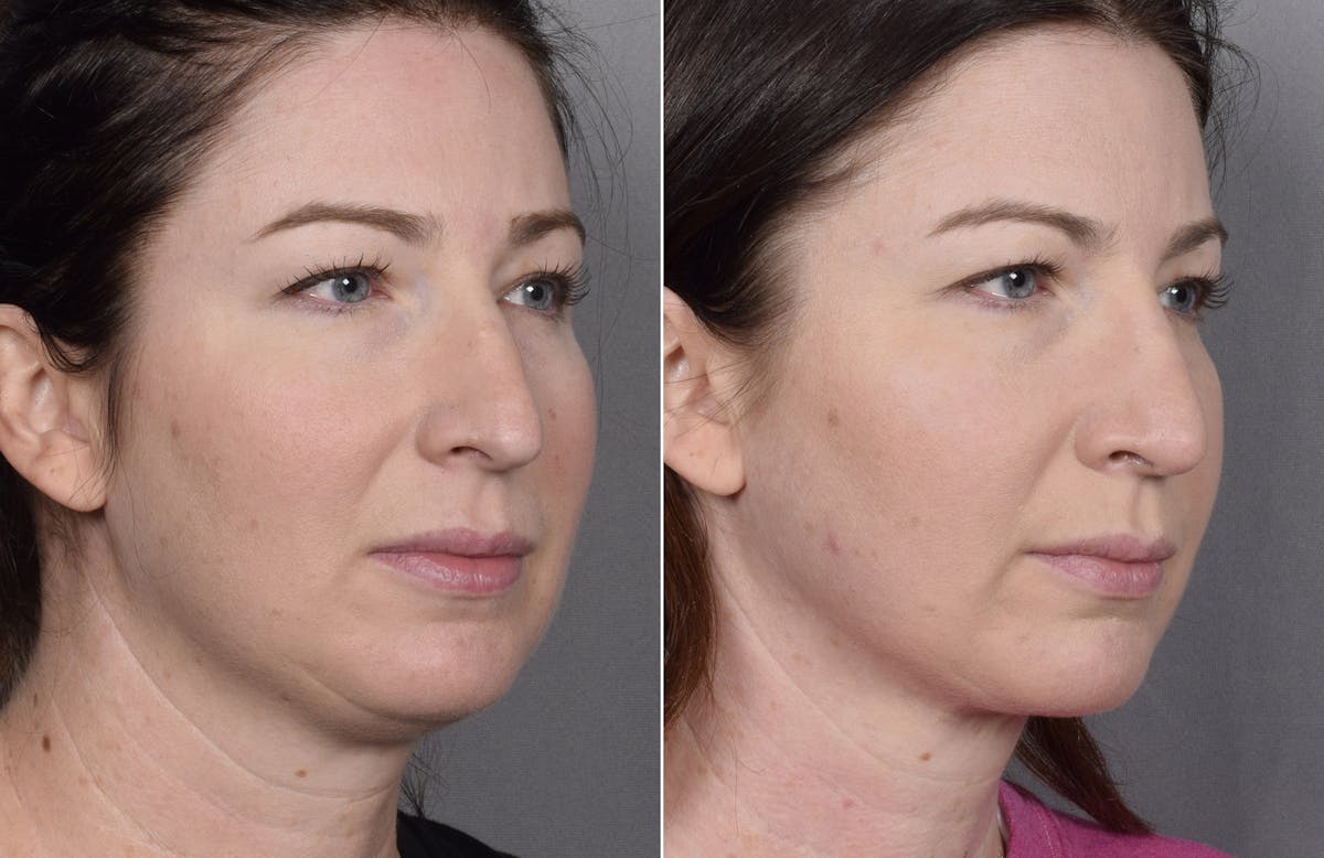 Rhinoplasty Before & After Gallery - Patient 418400 - Image 4