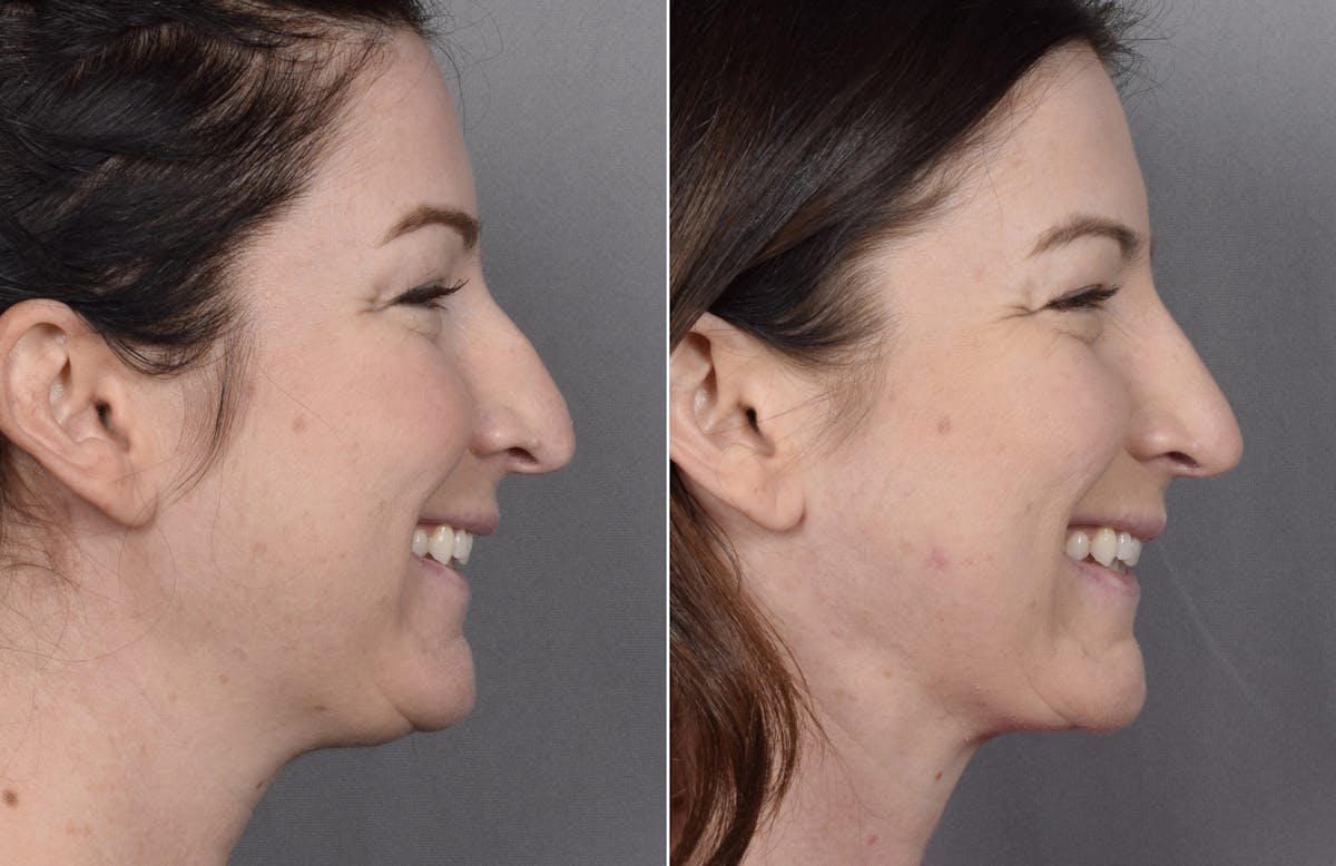 Rhinoplasty Before & After Gallery - Patient 418400 - Image 1