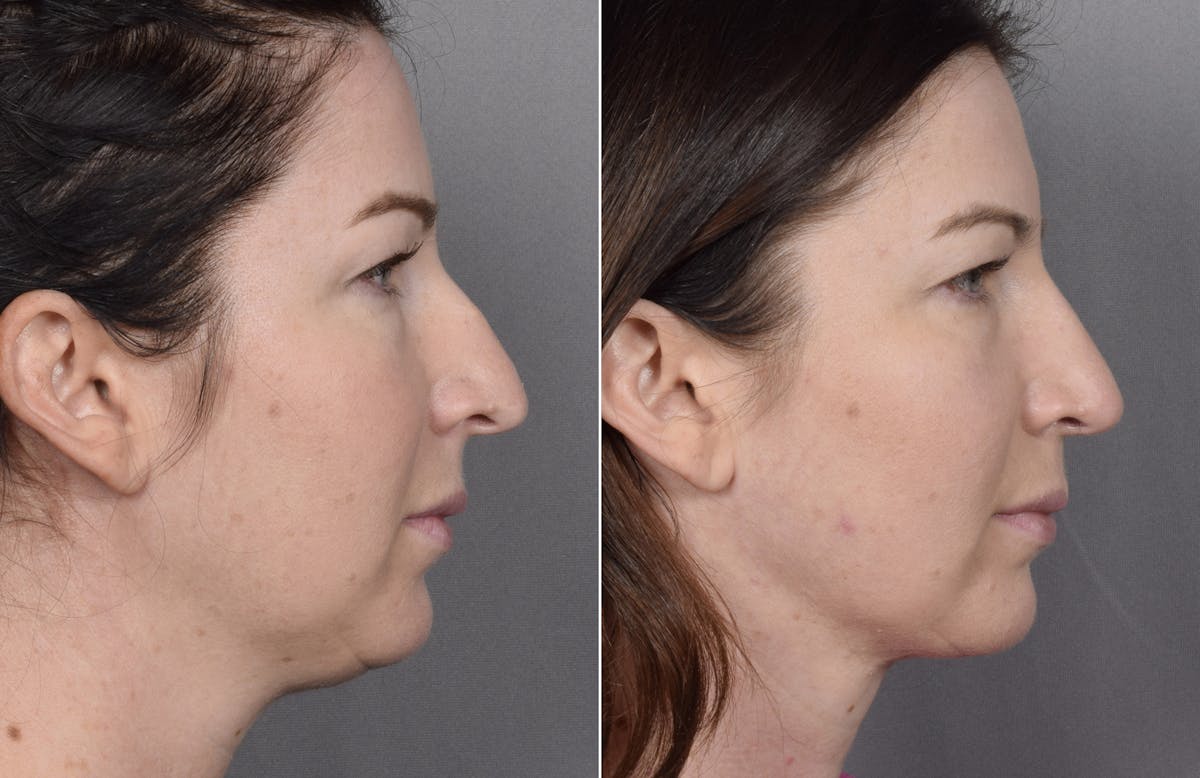Rhinoplasty Before & After Gallery - Patient 418400 - Image 2