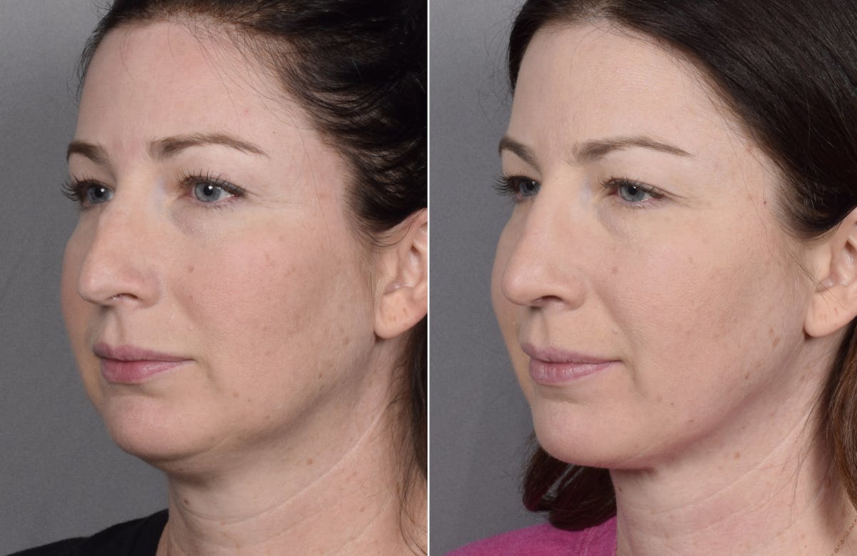 Rhinoplasty Before & After Gallery - Patient 418400 - Image 5