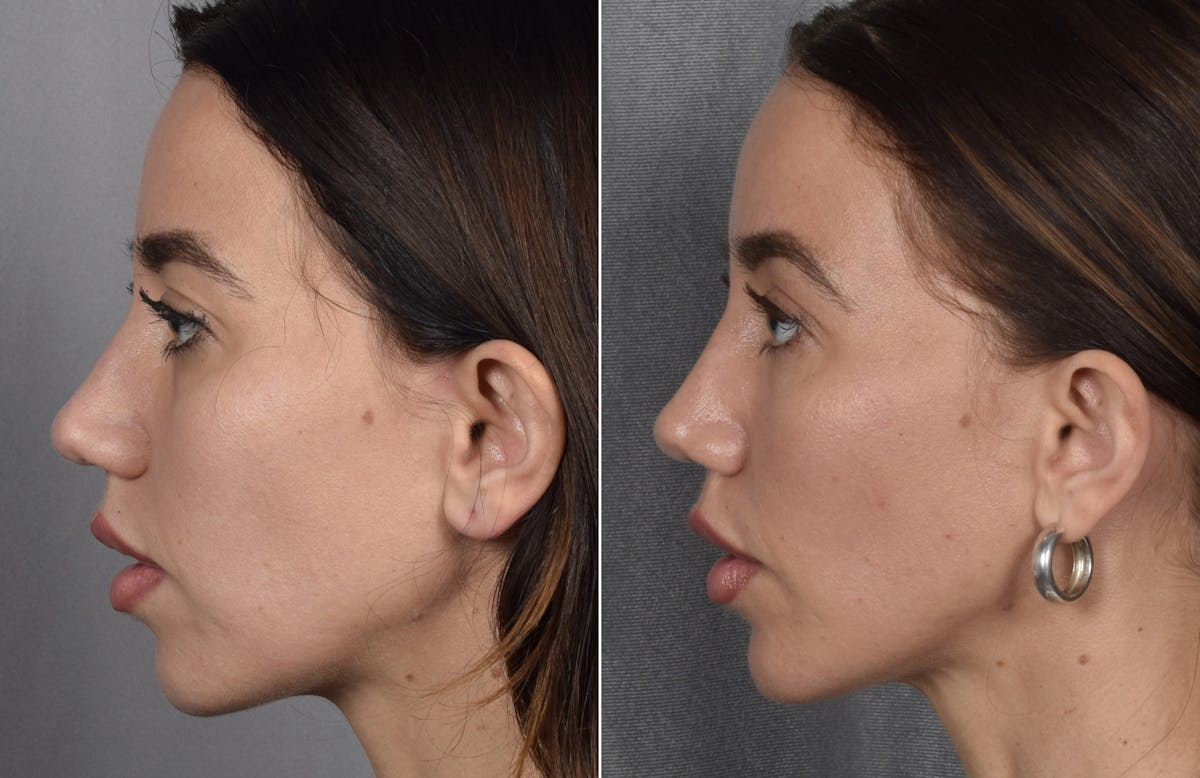 Rhinoplasty Before & After Gallery - Patient 693510 - Image 8