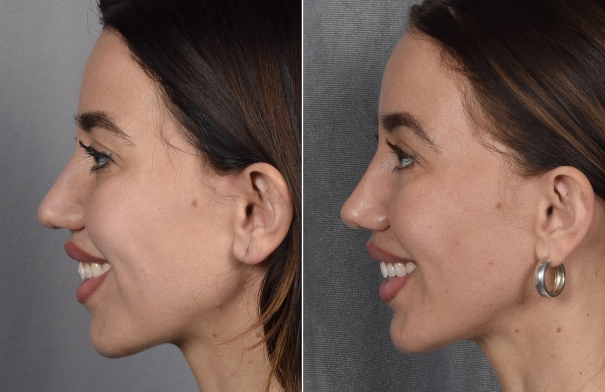 Rhinoplasty Before & After Gallery - Patient 693510 - Image 4