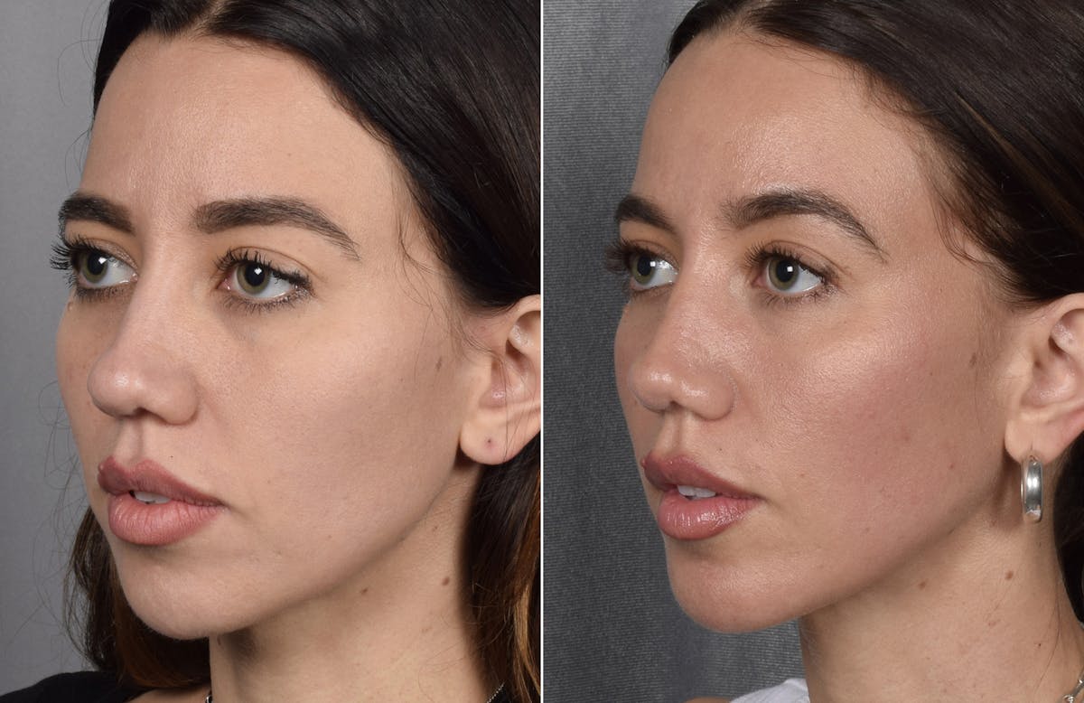 Rhinoplasty Before & After Gallery - Patient 693510 - Image 6