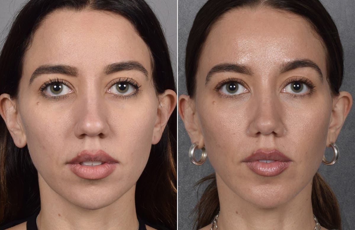 Rhinoplasty Before & After Gallery - Patient 693510 - Image 3