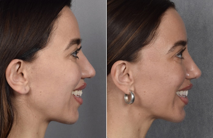 Rhinoplasty Before & After Gallery - Patient 693510 - Image 1