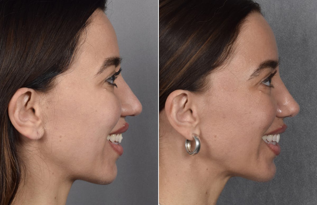 Rhinoplasty Before & After Gallery - Patient 693510 - Image 1