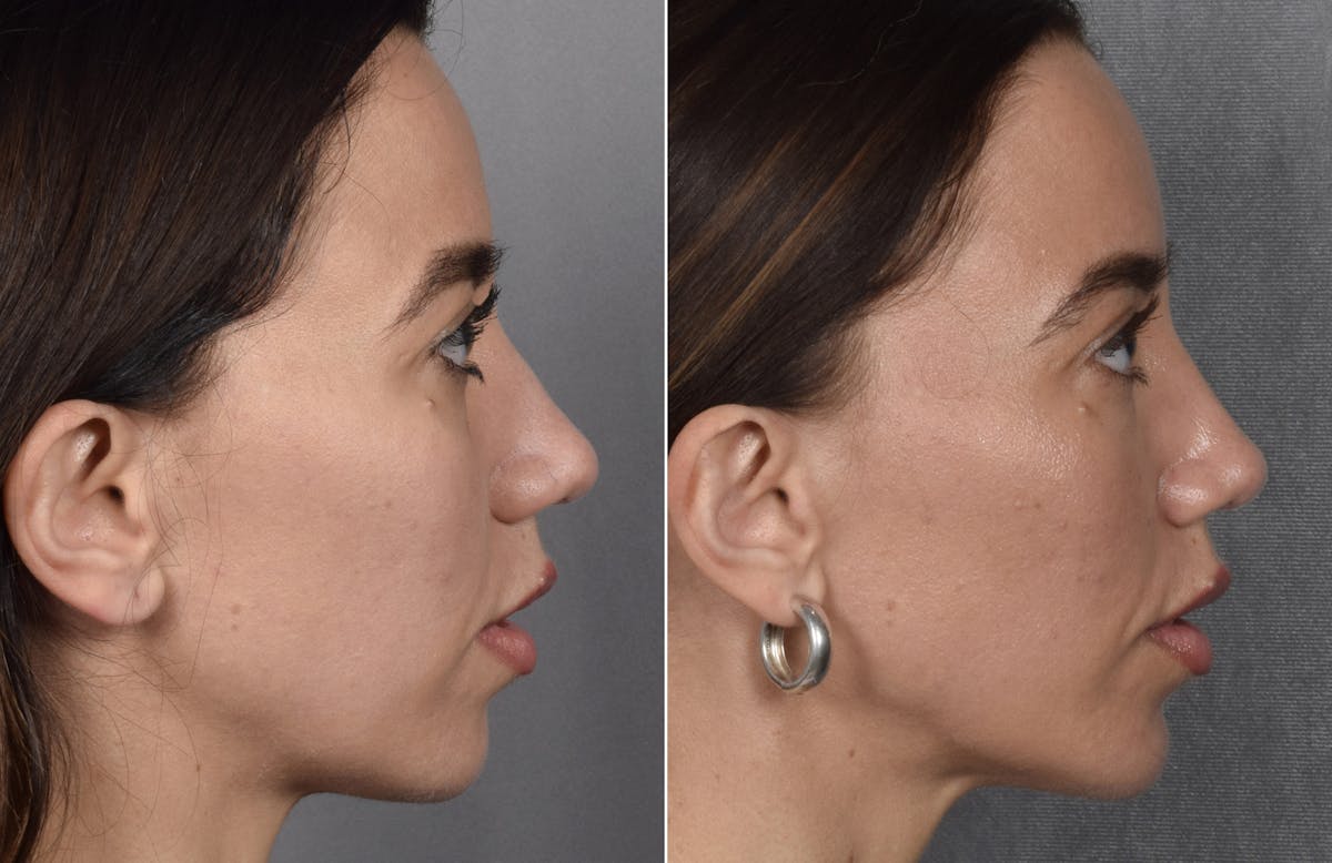 Rhinoplasty Before & After Gallery - Patient 693510 - Image 2