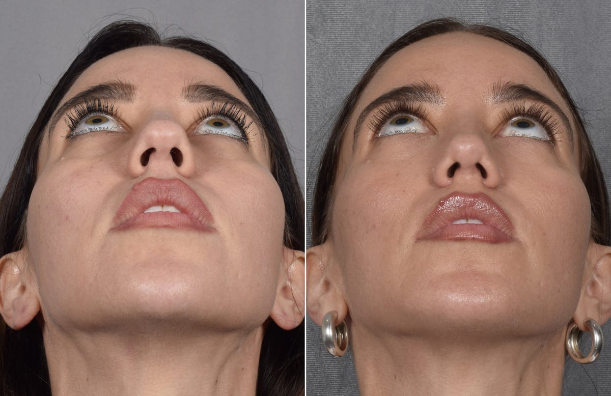 Rhinoplasty Before & After Gallery - Patient 693510 - Image 5