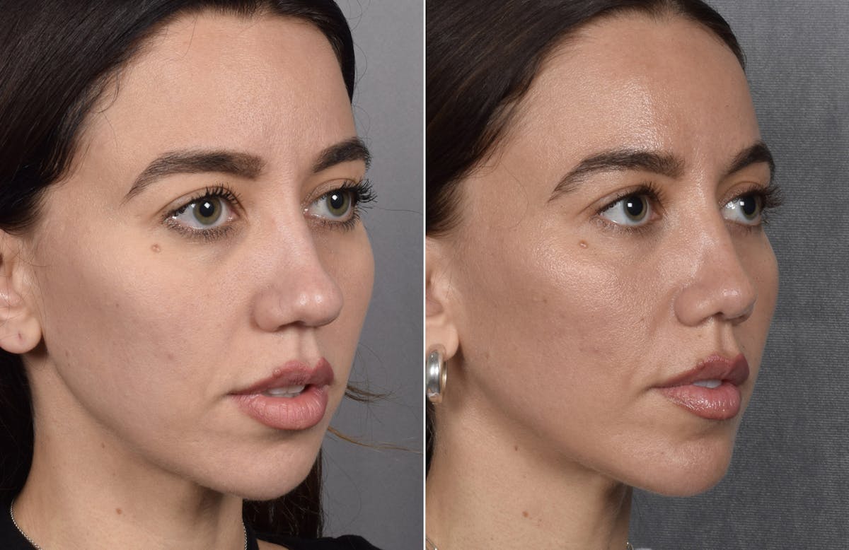 Rhinoplasty Before & After Gallery - Patient 693510 - Image 7