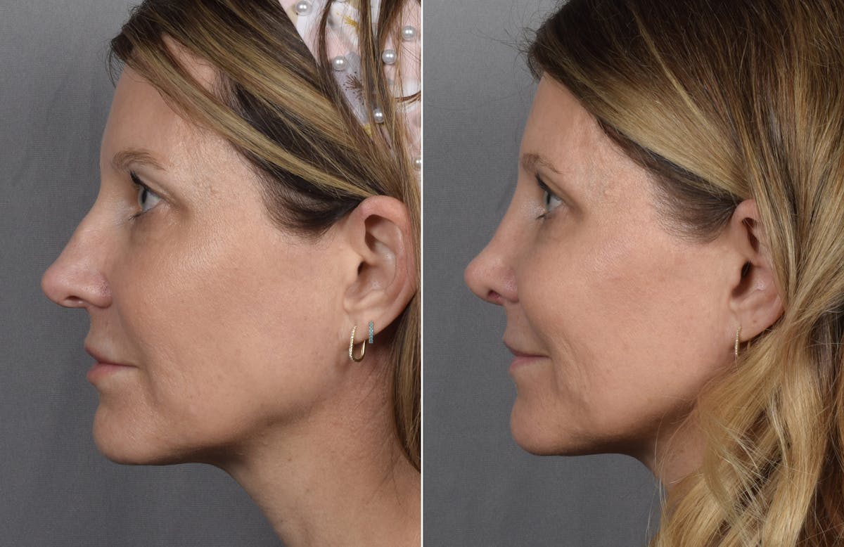 Rhinoplasty Before & After Gallery - Patient 215384 - Image 6