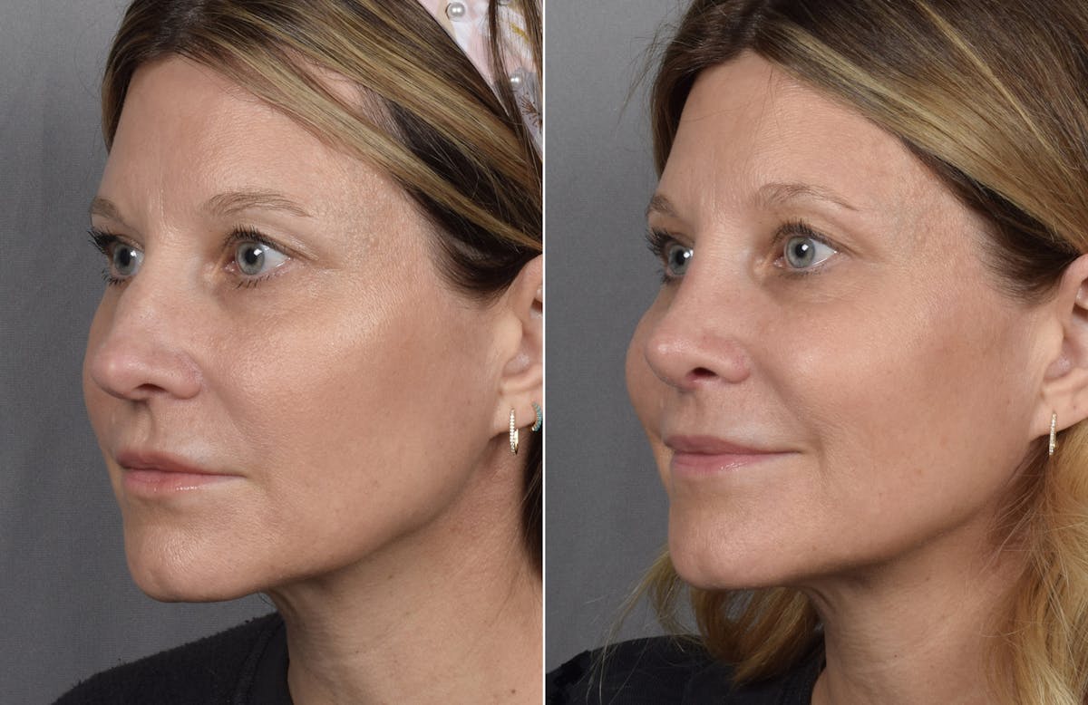Rhinoplasty Before & After Gallery - Patient 215384 - Image 4