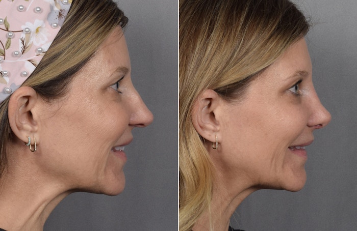 Rhinoplasty Before & After Gallery - Patient 215384 - Image 1