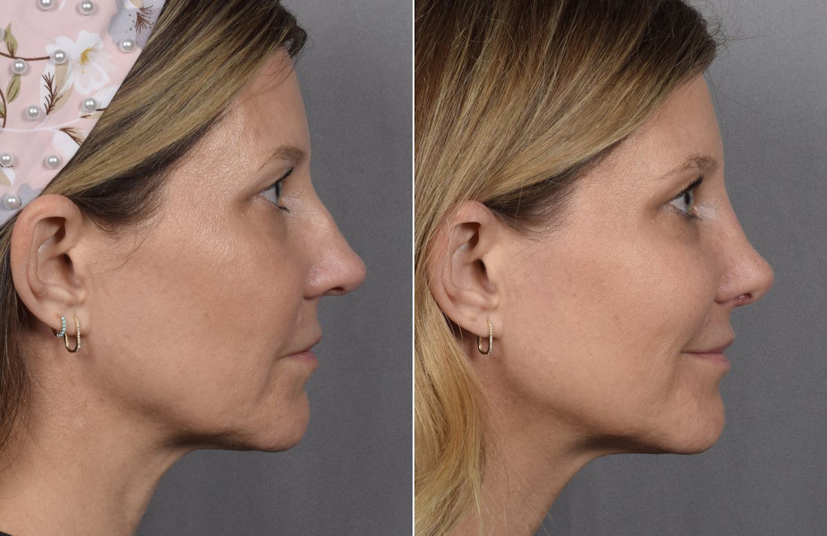 Rhinoplasty Before & After Gallery - Patient 215384 - Image 2