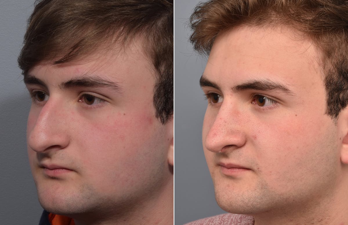 Rhinoplasty Before & After Gallery - Patient 124777 - Image 5