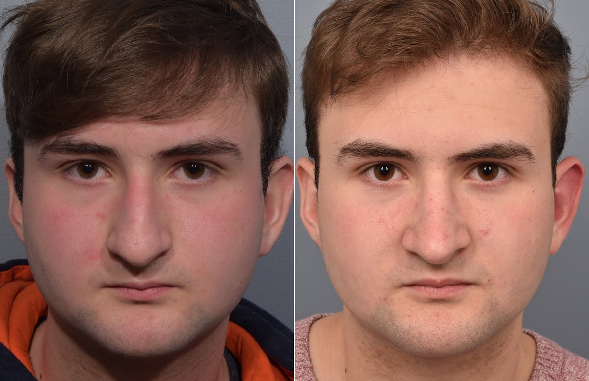 Rhinoplasty Before & After Gallery - Patient 124777 - Image 3