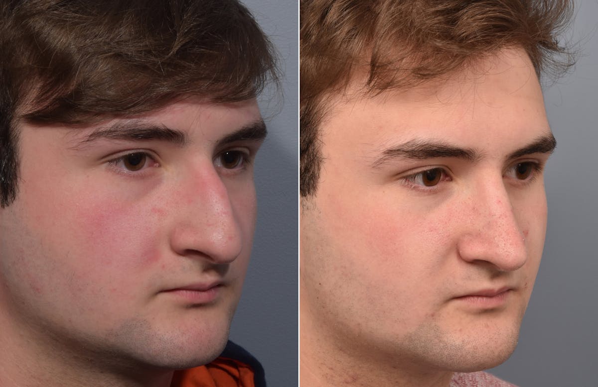 Rhinoplasty Before & After Gallery - Patient 124777 - Image 4