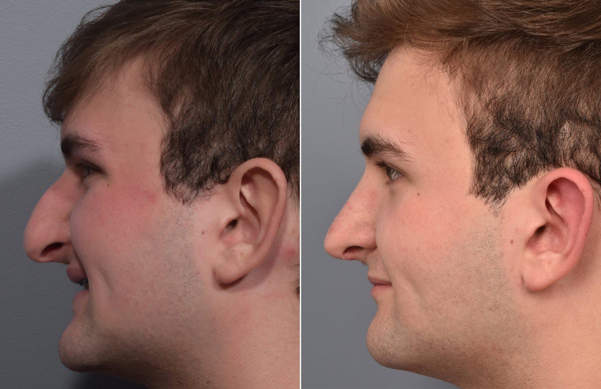 Rhinoplasty Before & After Gallery - Patient 124777 - Image 7