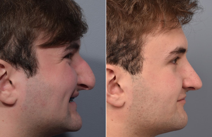 Rhinoplasty Before & After Gallery - Patient 124777 - Image 1