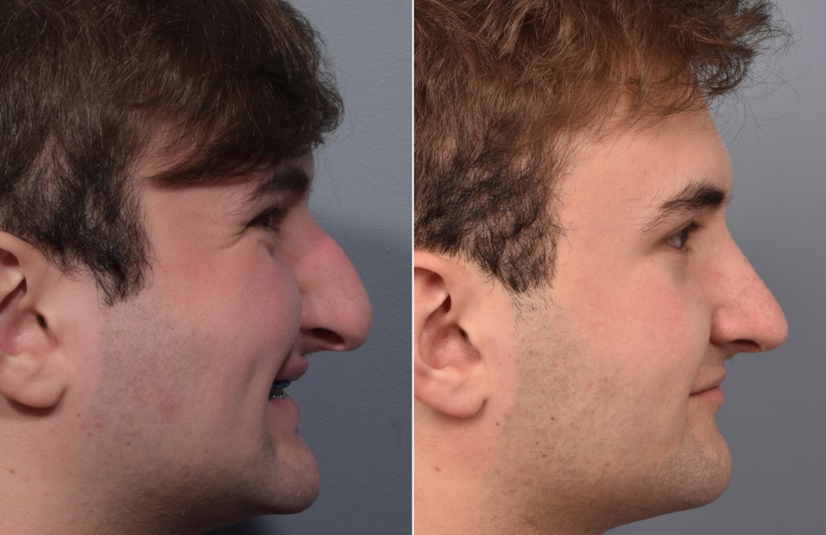 Rhinoplasty Before & After Gallery - Patient 124777 - Image 1