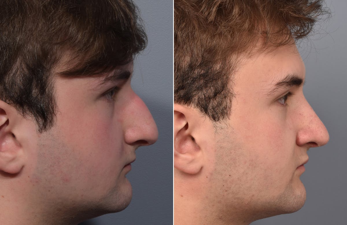 Rhinoplasty Before & After Gallery - Patient 124777 - Image 2