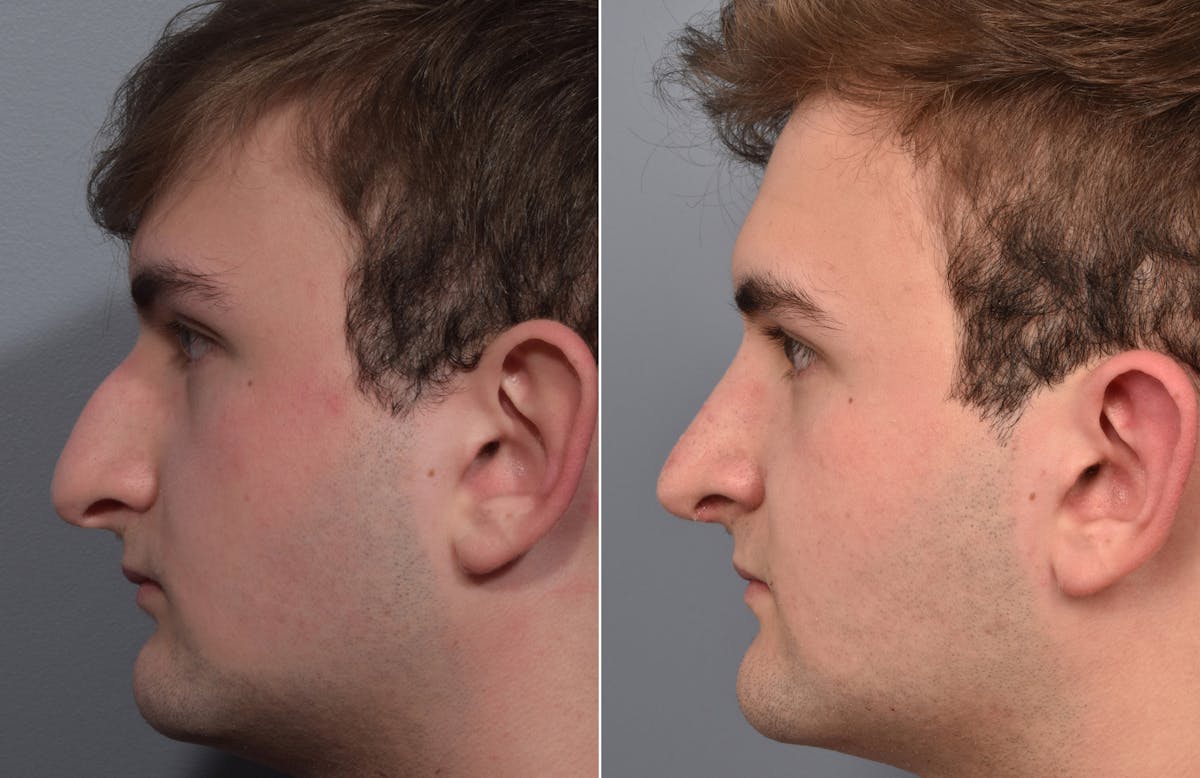 Rhinoplasty Before & After Gallery - Patient 124777 - Image 6