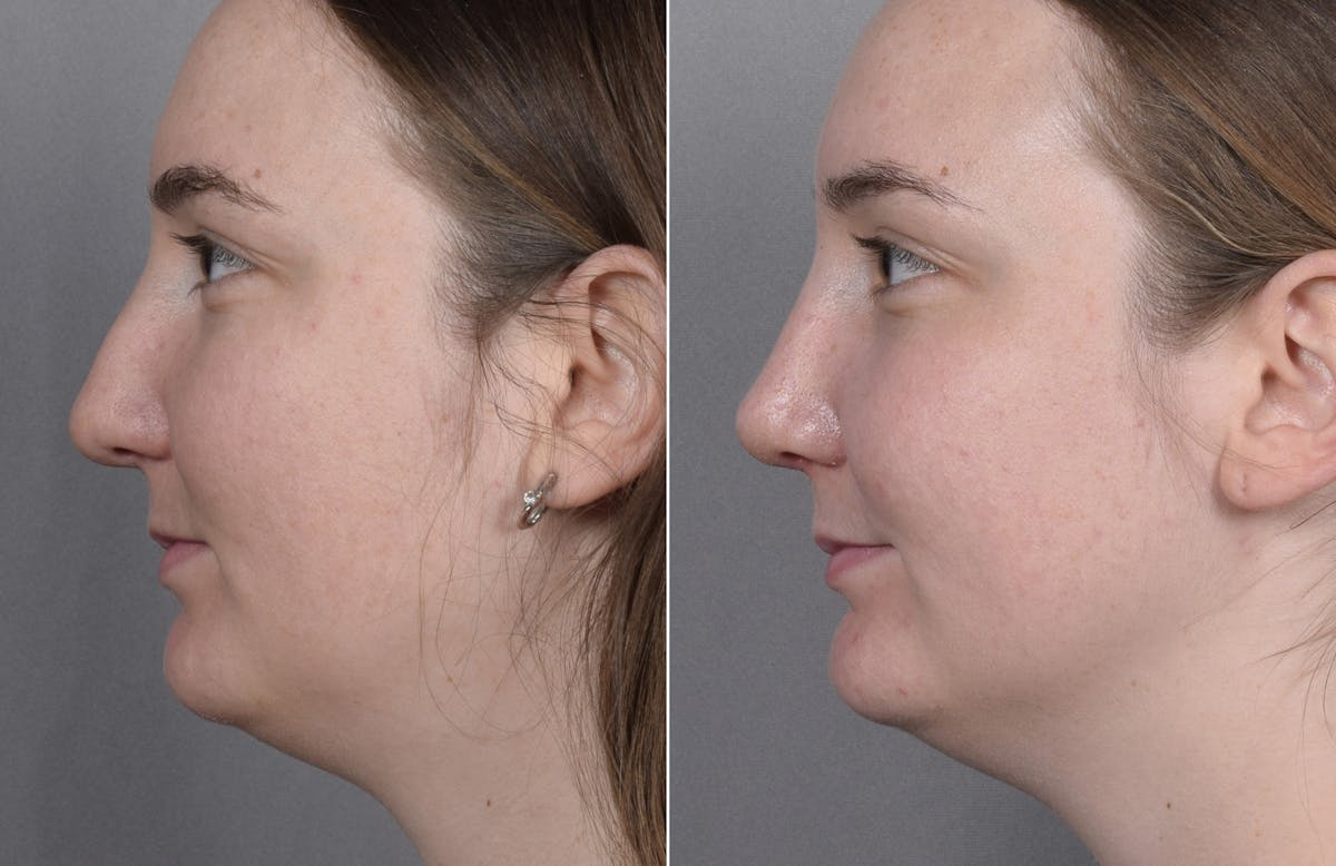 Rhinoplasty Before & After Gallery - Patient 130693 - Image 6