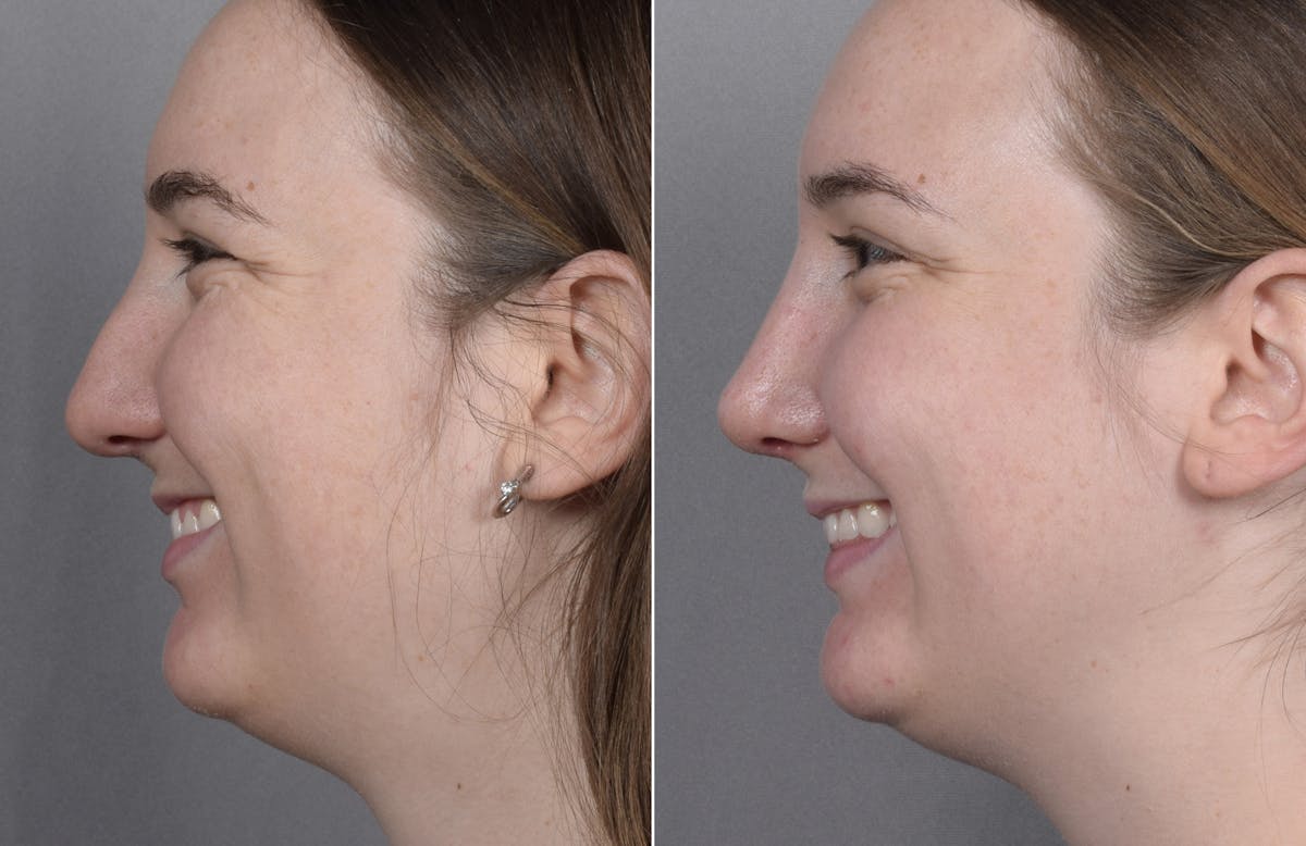 Rhinoplasty Before & After Gallery - Patient 130693 - Image 7