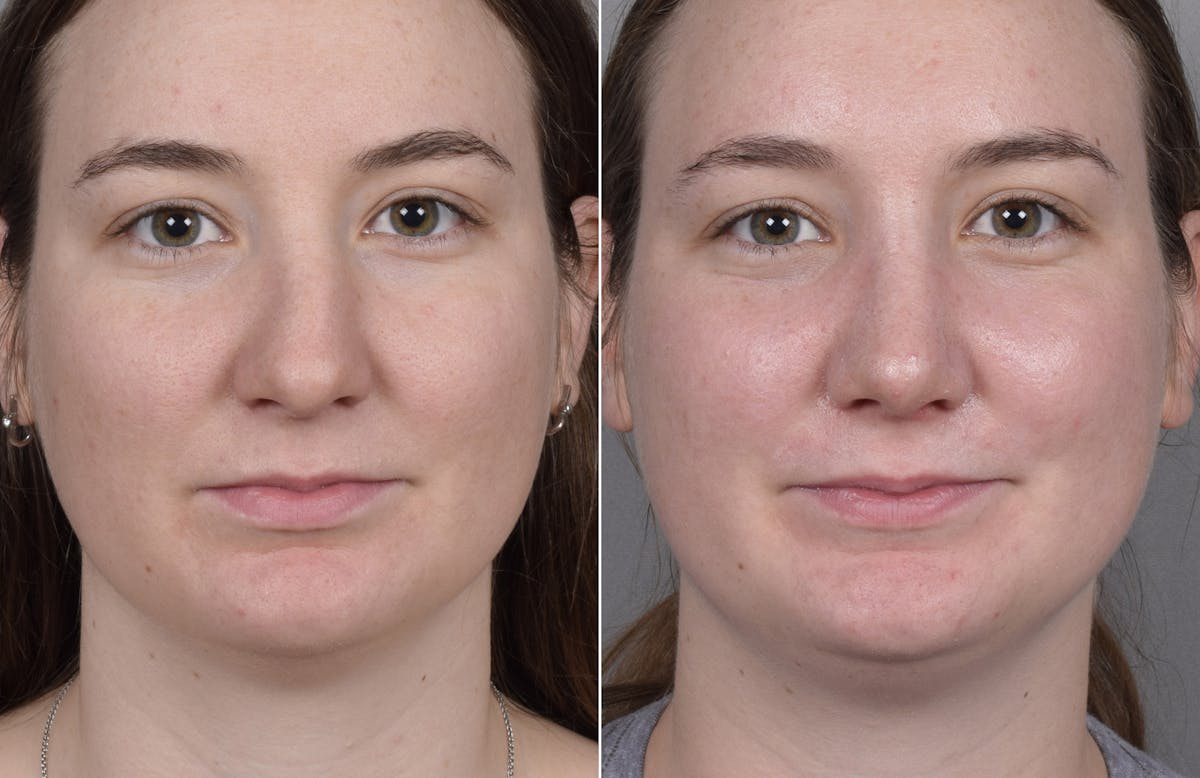 Rhinoplasty Before & After Gallery - Patient 130693 - Image 3