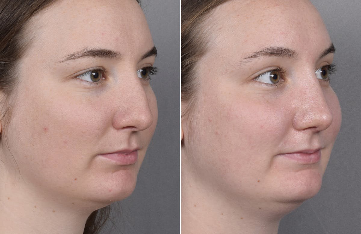 Rhinoplasty Before & After Gallery - Patient 130693 - Image 4
