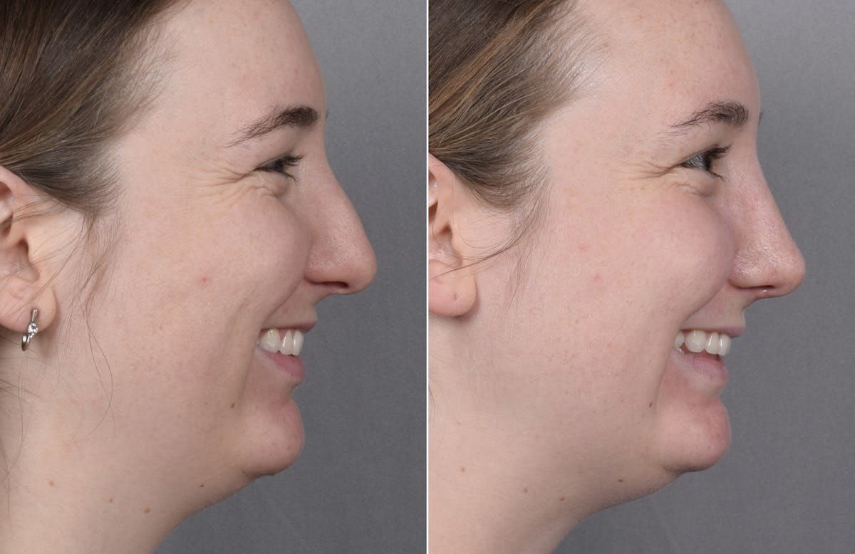 Rhinoplasty Before & After Gallery - Patient 130693 - Image 1