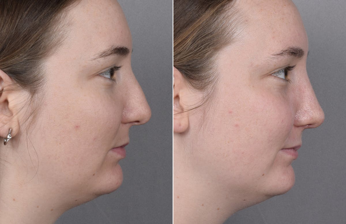 Rhinoplasty Before & After Gallery - Patient 130693 - Image 2