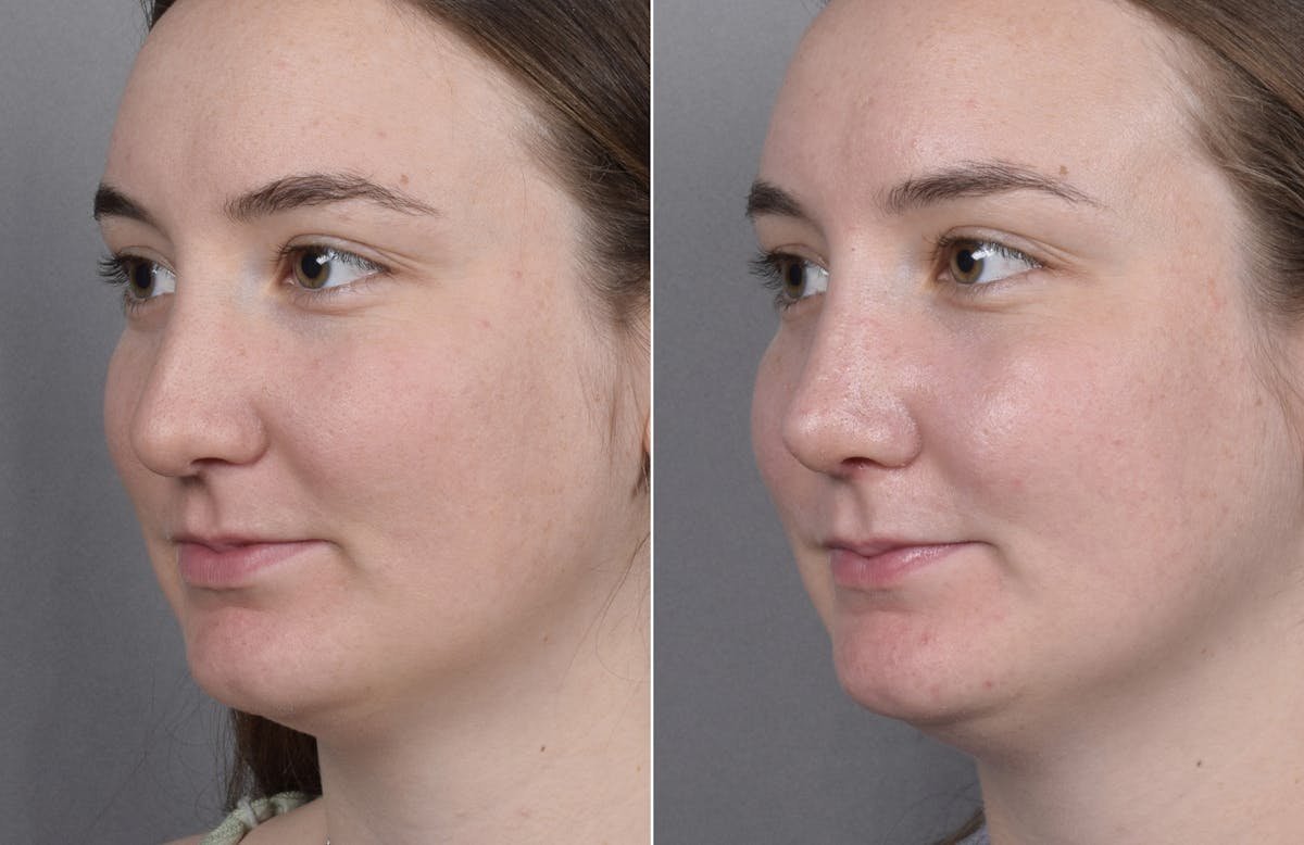 Rhinoplasty Before & After Gallery - Patient 130693 - Image 5