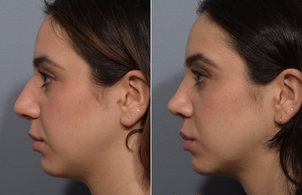 Rhinoplasty Before & After Gallery - Patient 904879 - Image 7