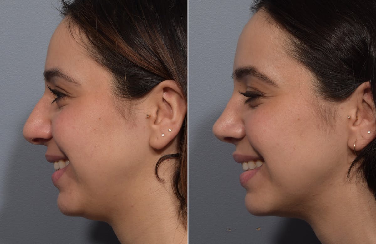 Rhinoplasty Before & After Gallery - Patient 904879 - Image 6