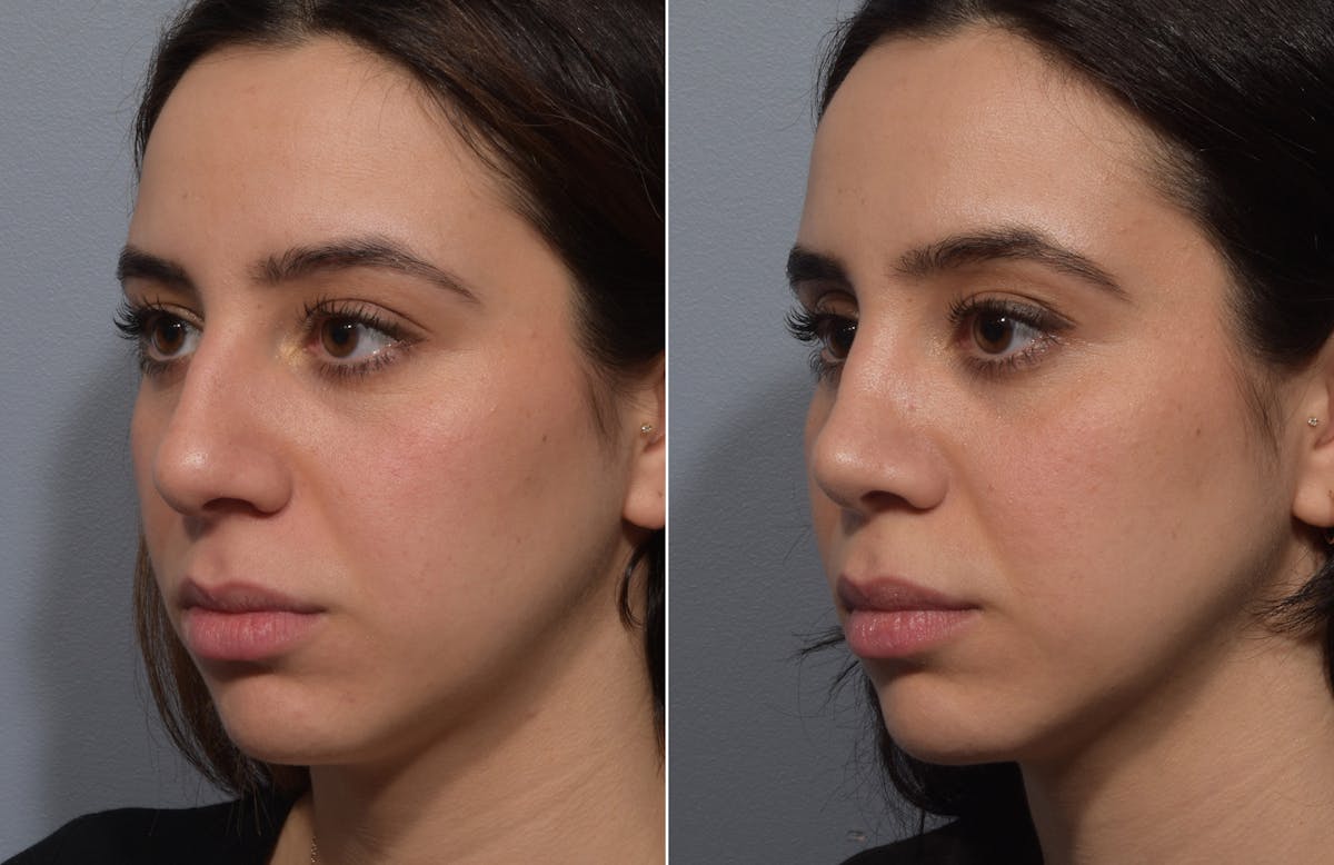 Rhinoplasty Before & After Gallery - Patient 904879 - Image 5