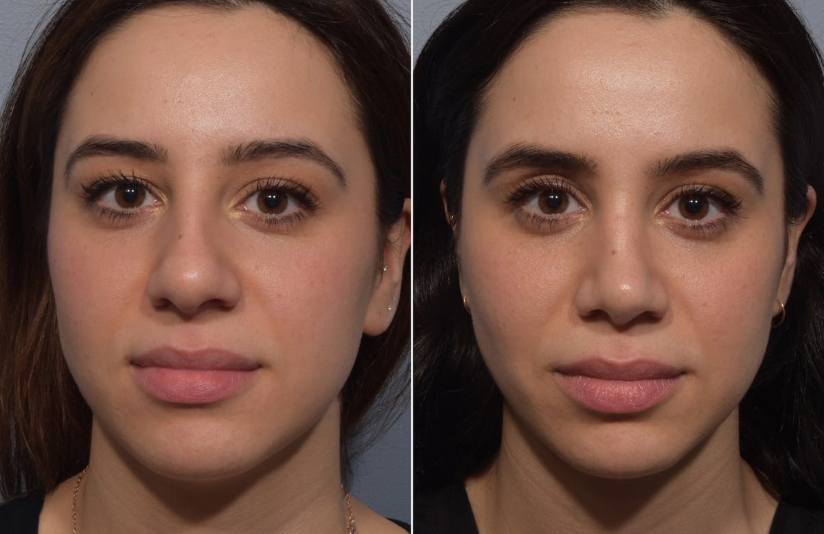 Rhinoplasty Before & After Gallery - Patient 904879 - Image 3
