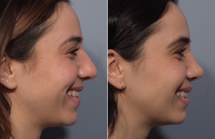 Rhinoplasty Before & After Gallery - Patient 904879 - Image 1