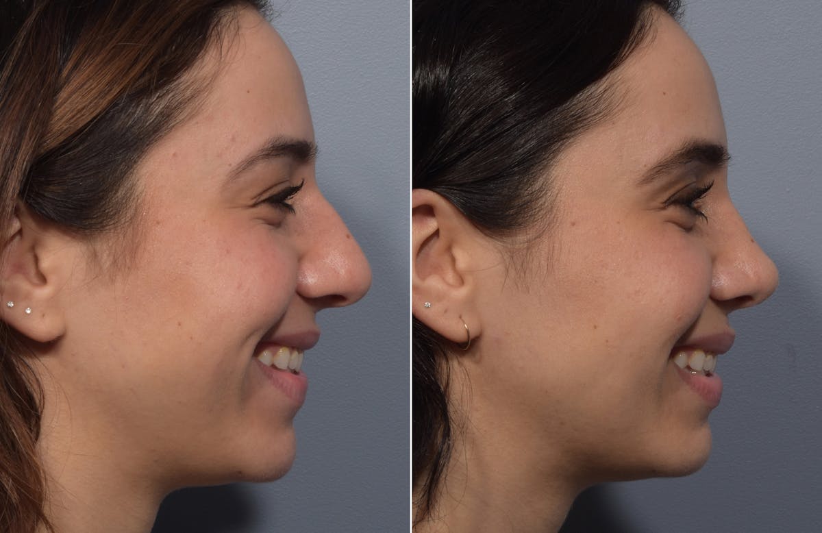 Rhinoplasty Before & After Gallery - Patient 904879 - Image 1