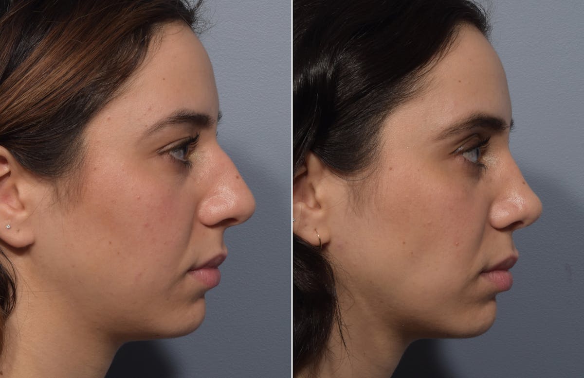 Rhinoplasty Before & After Gallery - Patient 904879 - Image 2