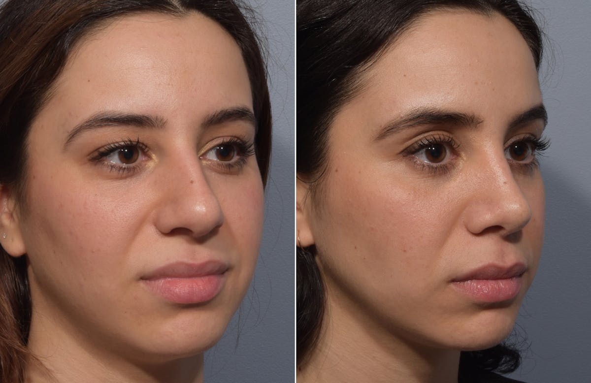 Rhinoplasty Before & After Gallery - Patient 904879 - Image 4