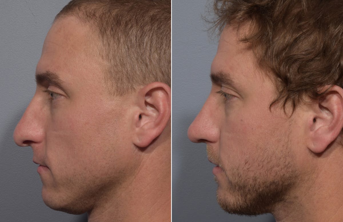 Rhinoplasty Before & After Gallery - Patient 241882 - Image 6