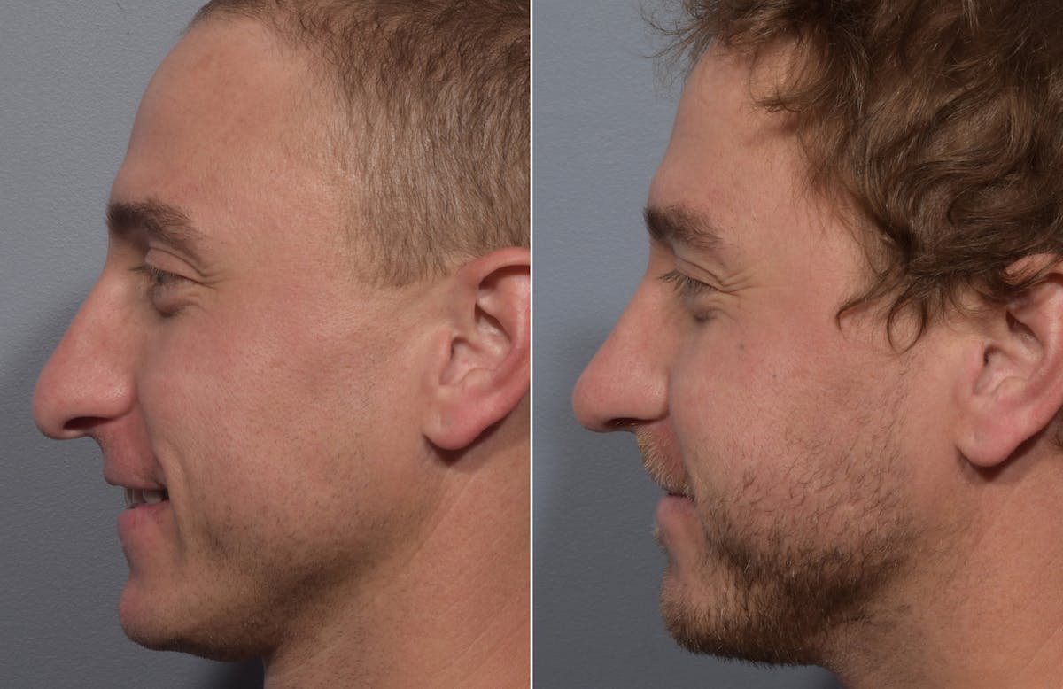 Rhinoplasty Before & After Gallery - Patient 241882 - Image 7