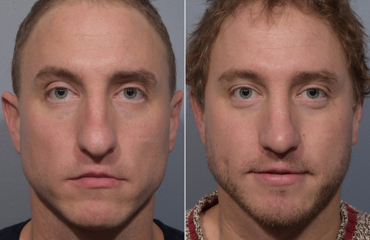 Rhinoplasty Before & After Gallery - Patient 241882 - Image 3