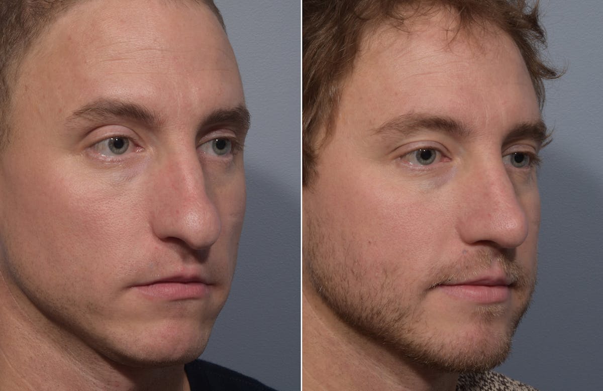 Rhinoplasty Before & After Gallery - Patient 241882 - Image 4