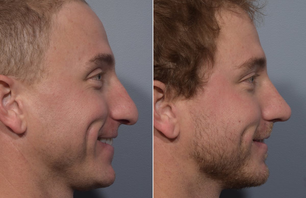 Rhinoplasty Before & After Gallery - Patient 241882 - Image 1