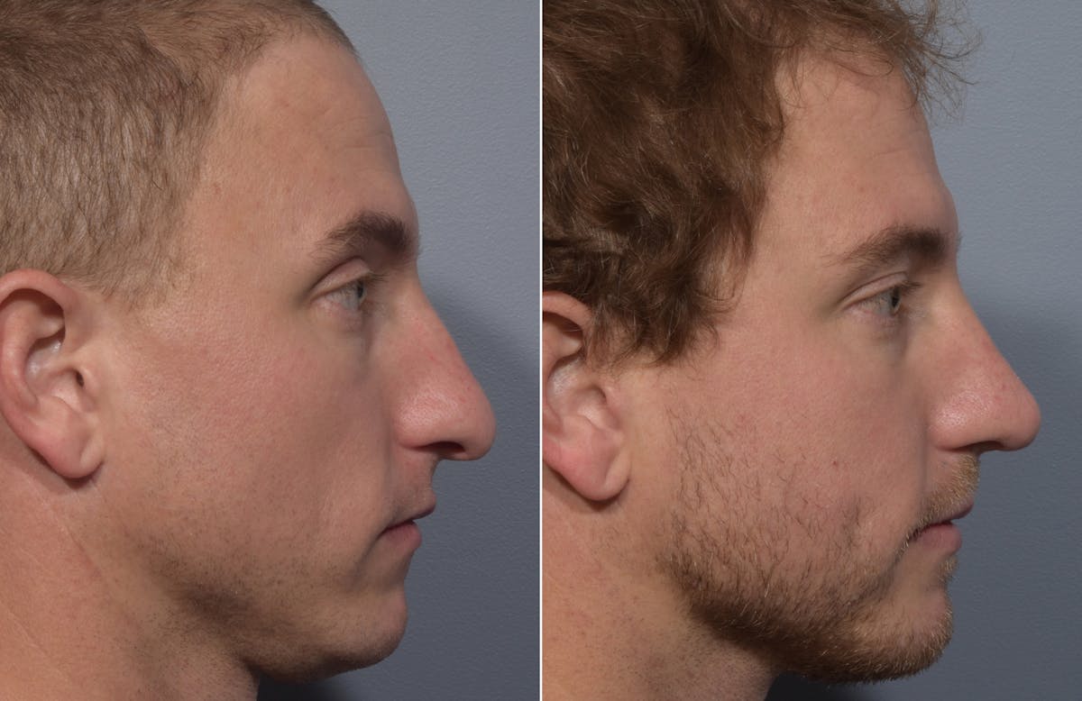 Rhinoplasty Before & After Gallery - Patient 241882 - Image 2