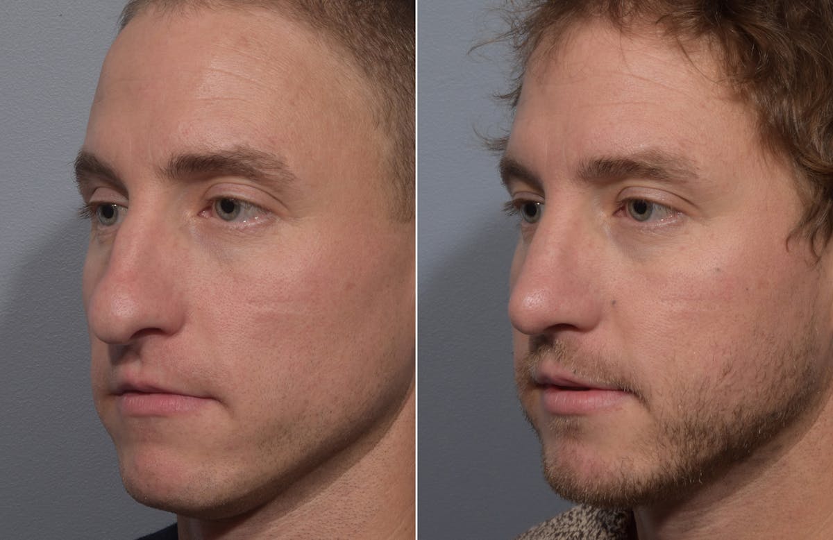 Rhinoplasty Before & After Gallery - Patient 241882 - Image 5