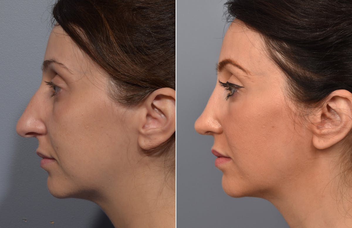 Rhinoplasty Before & After Gallery - Patient 110870 - Image 6