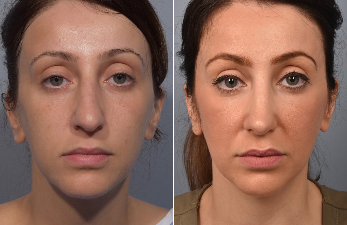 Rhinoplasty Before & After Gallery - Patient 110870 - Image 3